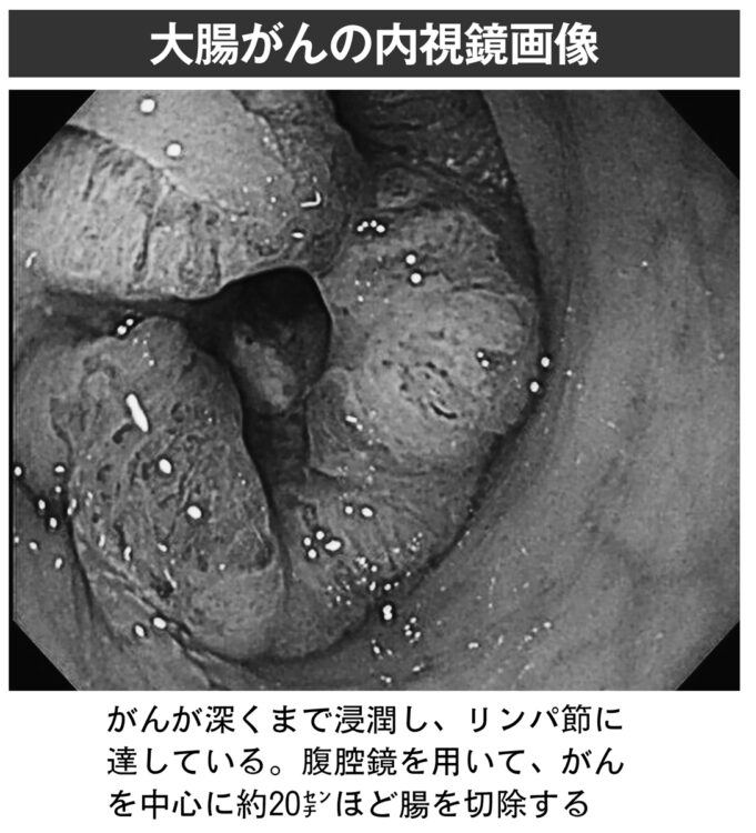 大腸がんの内視鏡画像