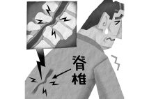 腰部脊柱管狭窄症の治療はここ10年で進化（イラスト／いかわやすとし）