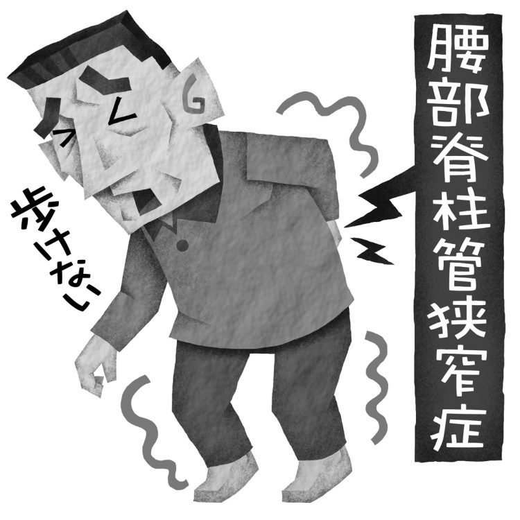 重症の腰部脊柱管狭窄症はどう治療する？（イラスト／いかわやすとし）
