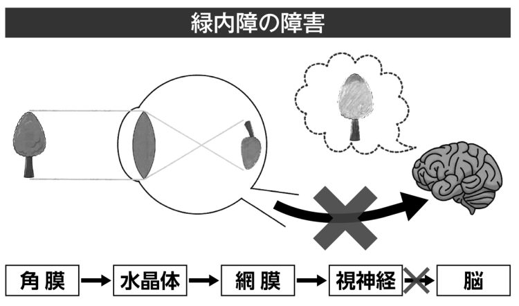 緑内障の障害