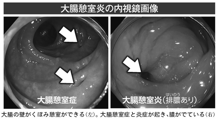 大腸憩室炎の内視鏡