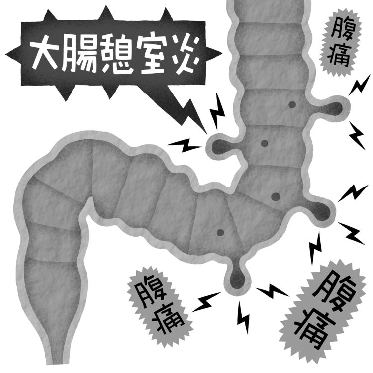 日本人の大腸憩室保有者は4人に1人と推計されている（イラスト／いかわやすとし）