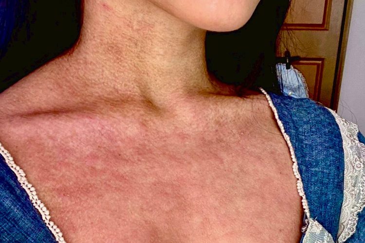 生後数カ月の頃から、“アトピー性皮膚炎”に悩まされていた