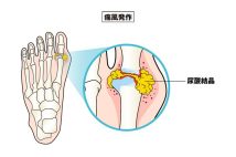 高尿酸血症が「痛風」を引き起こす仕組み 足の親指の付け根が腫れて靴が履けない…尿酸値が正常値でも発作が起こる理由とは【専門医が解説】