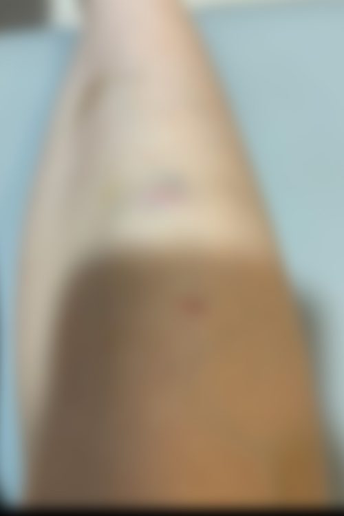 田中容疑者から靴べらで殴られできた痣