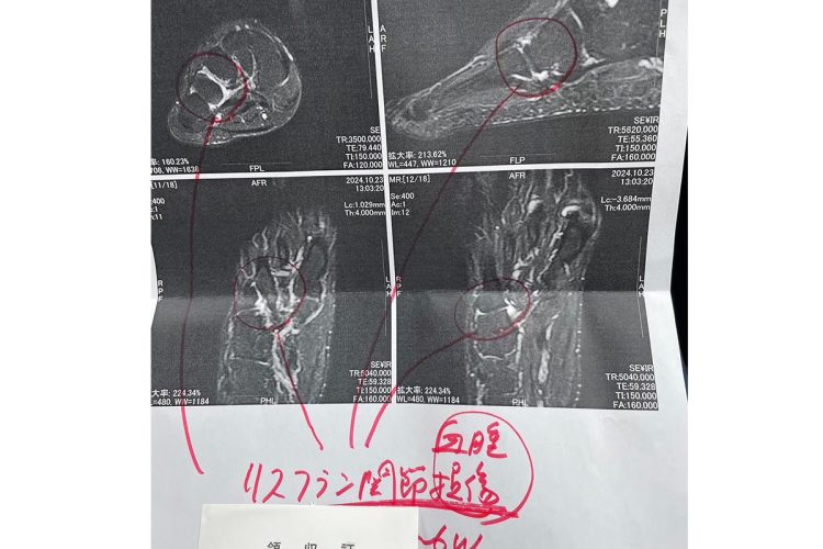 傘で足をさされるなどしてヒビが入るほどの被害が(写真はAさん提供)