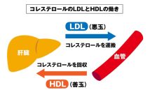 自覚症状がないため放置されやすい「脂質異常症」 コレステロールの異常が動脈硬化を引き起こし心筋梗塞や脳梗塞のリスクを高める【専門医が解説】