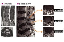 MRIの画像診断でも原因が特定しにくい「慢性腰痛」、痛みの感じ方には脳が深く関係　運動器の障害か精神医学的な要因か、見分ける検査方法とは【専門医が解説】