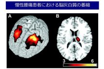 慢性腰痛患者の「萎縮した脳」は治療でもとに戻すことができる　治療の第一選択肢は運動療法と認知行動療法の組み合わせ【専門医が解説】