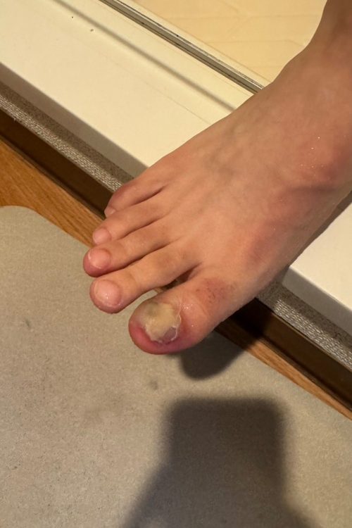 209km完走で足がやばいことになる